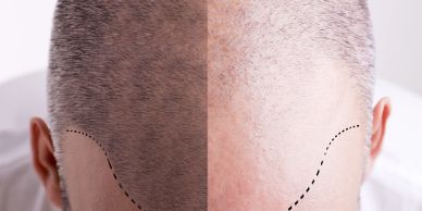 Before and after hair transplant comparison on scalp.