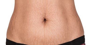 Close-up of a stomach with visible stretch marks and skin texture.