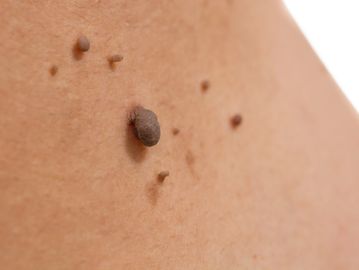 Laser skin tag removal