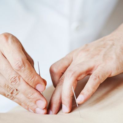 Close-up of acupuncture needles being inserted into skin by a practitioner.