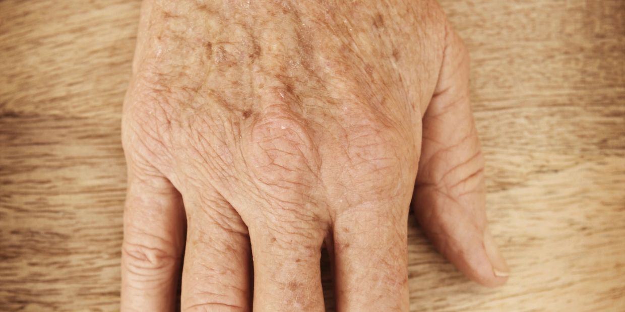 Mature hand with dark spots of biofilm and visible Demodex mites.