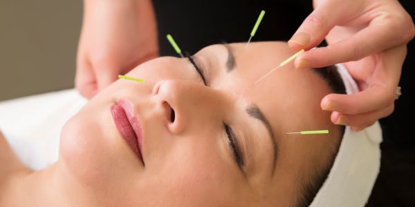 Woman receiving facial acupuncture treatment.