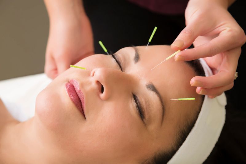 Spa series: middle aged woman in the spa getting acupuncture treatment. You might also be interested in these: