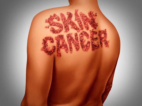 mole checking service, map my mole partner, benign mole treatment flintshire, north Wales, Chester 