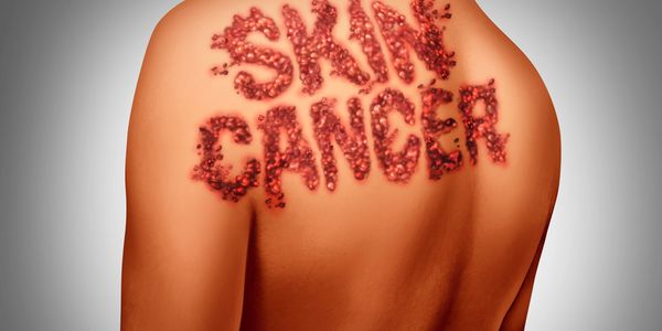 mole checking service, map my mole partner, benign mole treatment flintshire, north Wales, Chester 