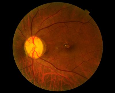 Close-up image of the human retina showing optic nerve and blood vessels.
