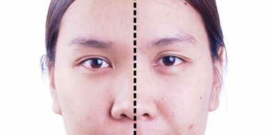 Split face showing clear skin on left and acne-prone skin on right.