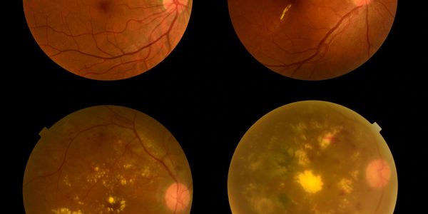 Eye Exams in Houston