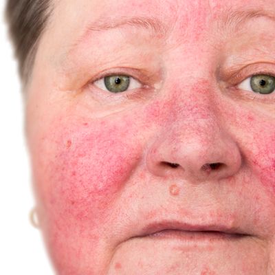 Rosacea Clinic Brisbane. Target Unwanted Redness And Facial Flushing With Laser Treatments Brisbane
