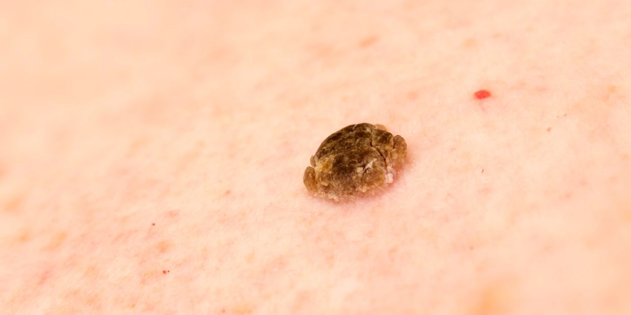 Instant seborrhoeic keratosis removal, hawarden, Deeside, Chester, wirral, safe