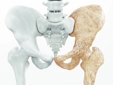 Comparison of solid and porous hip bone structures in 3D model.
