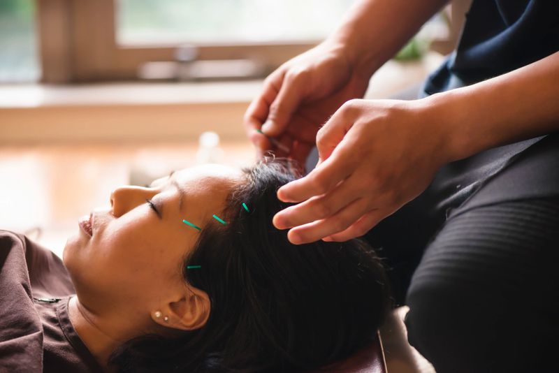 .Young woman, Japanese ethnicity, at the acupuncture treatment. Hands of acupuncturists inserting needles in her head. She lies at bright window. Close up.