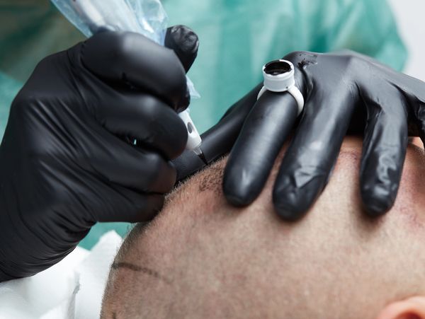 Close-up of scalp micropigmentation procedure.