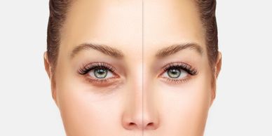 Close-up of a woman's eyes showing before and after under-eye treatment.
