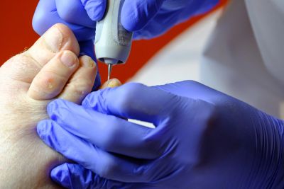 Professional applying nail treatment to a toenail.