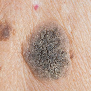 raised brown skin growth, waxy skin lesion removal - chester 