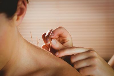 Acupuncture needles inserted in a person's upper back.