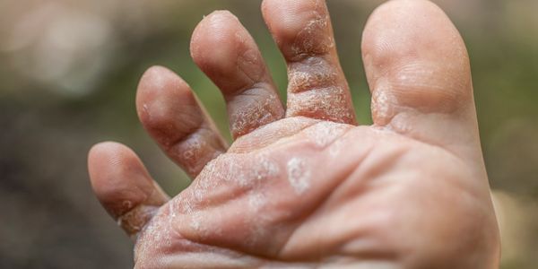 Ayak mantarı bulaşıcı bir hastalıktır.