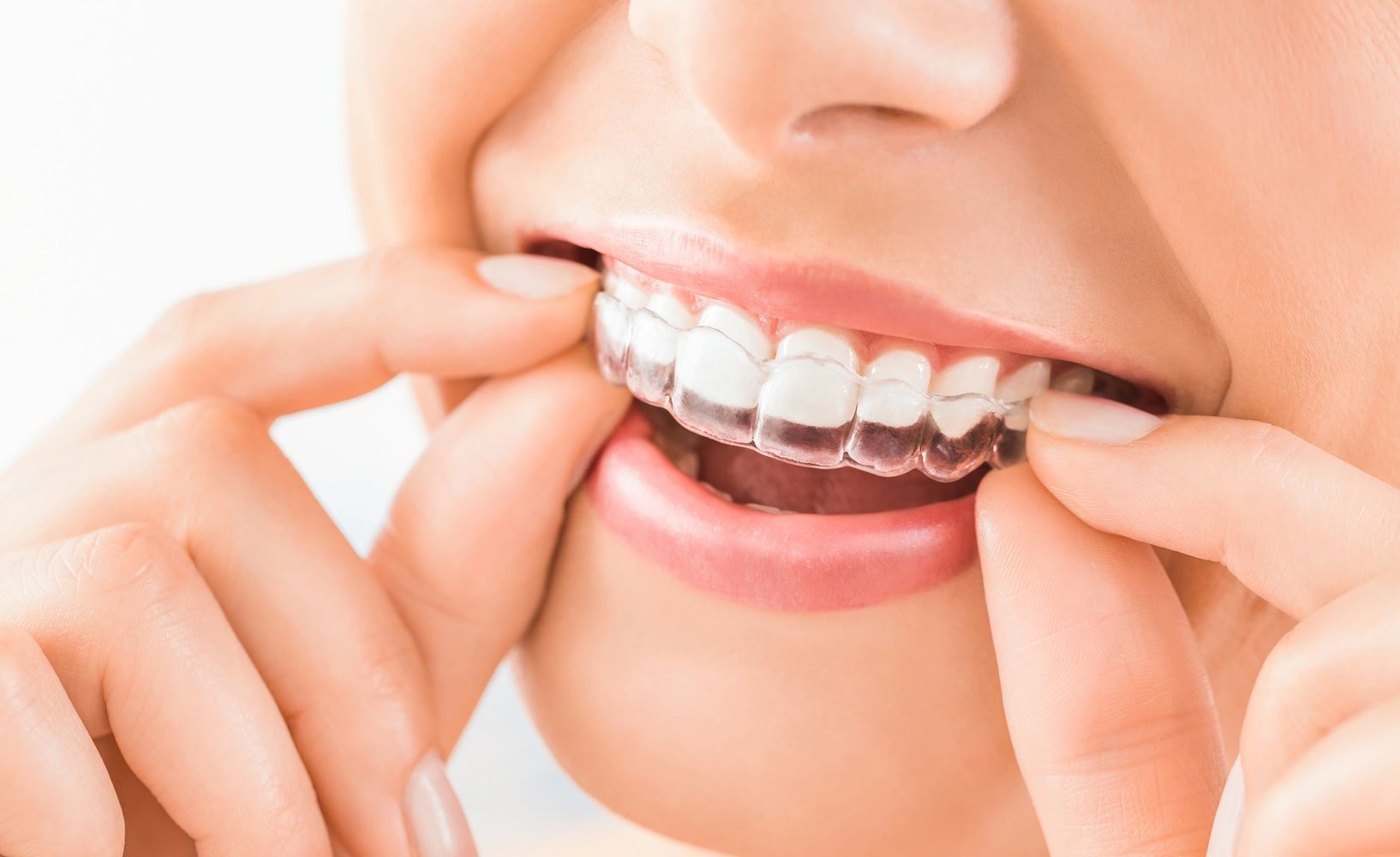 Person inserting a clear dental aligner on their teeth.