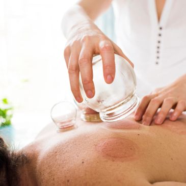 Therapist performing cupping therapy on a person's back.