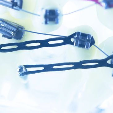 Temporary Anchorage Devices (TADs / Micro Implants)