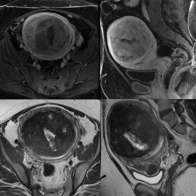 Pelvik görüntüleme için MRI kesitleri.
