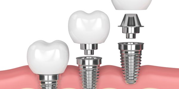 Dental implants with crown and abutment components.