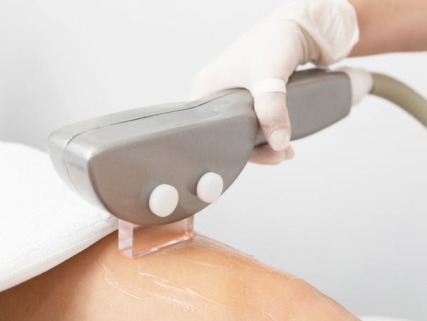 Eliminacion del Vello con Láser diodo en Castelldefels