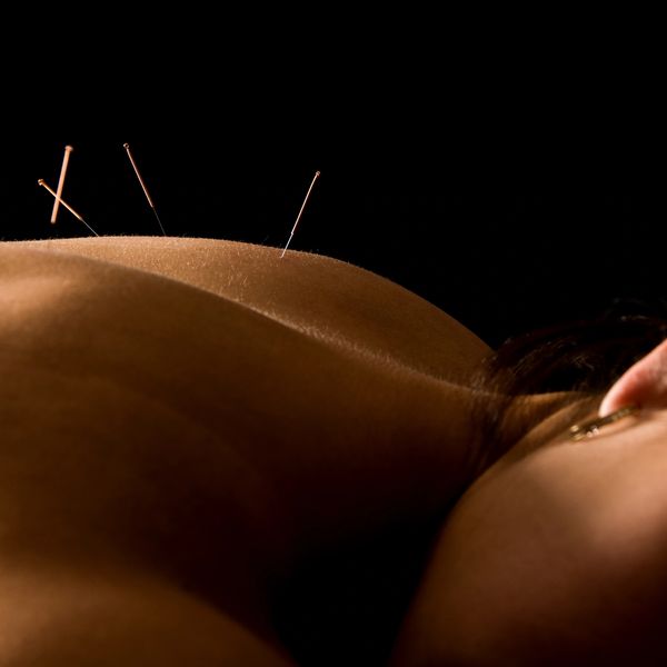 Back acupuncture treatment with needles inserted.