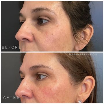 a picture showing before and after dermal filler under the eyes