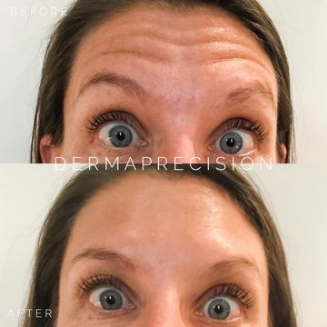 a picture showing before and after botox for the forehead lines 