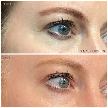 before and after picture showing the results of Vivace Ultra RF Microneedling