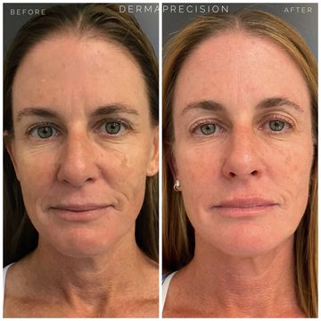 before and after picture showing the results of Sculptra