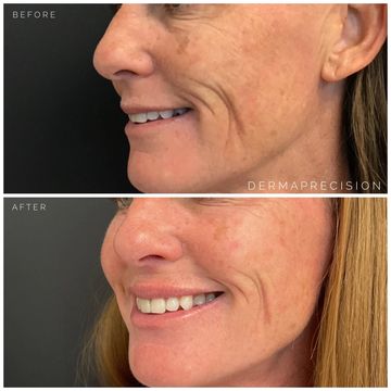 before and after picture showing the results of Sculptra