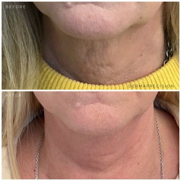 before and after picture showing the results of Vivace Ultra RF Microneedling