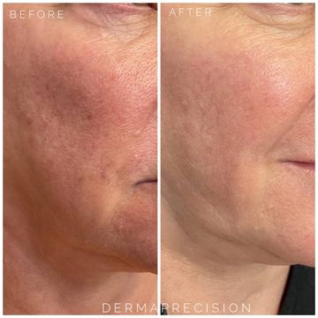 before and after picture showing the results of IPL therapy (photofacial)