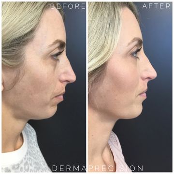 a picture showing before and after dermal filler in the chin