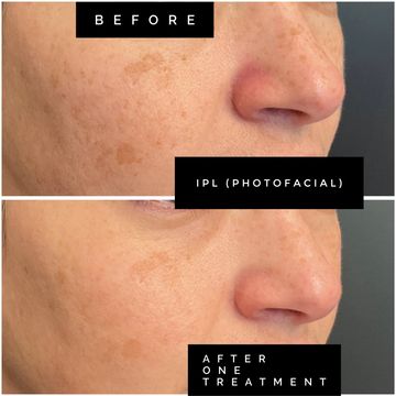 before and after picture showing the results of IPL therapy (photofacial)