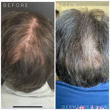 a picture of before and after hair restoration treatment