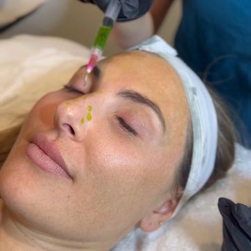 a picture of a woman getting BioRePeel put on her face
