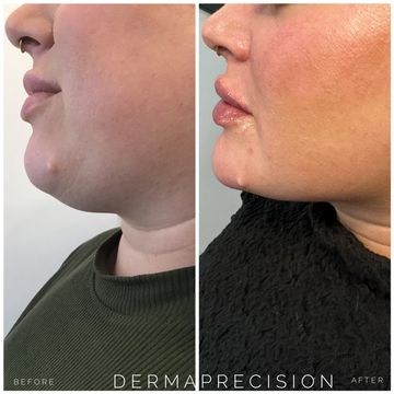 before and after picture showing the results of  fat dissolving kybella under the chin