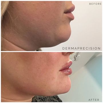 before and after picture showing the results of  fat dissolving kybella under the chin