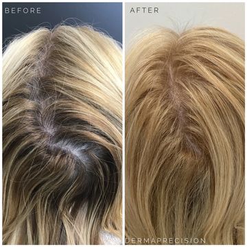 a picture of before and after hair restoration treatment