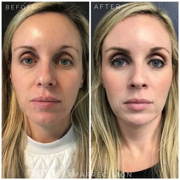 before and after picture showing the results of Sculptra