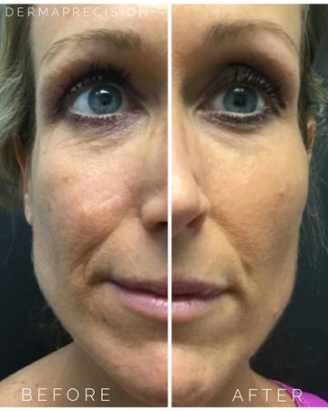 a picture showing before and after dermal filler in the smile lines