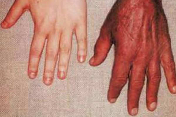 Does Excess Iron Cause Heart Disease?