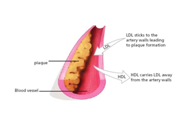 Low Levels of the Good Cholesterol Raise the Risk of Heart Disease