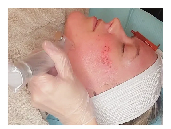 woman getting a micro-needling vampire facial. 