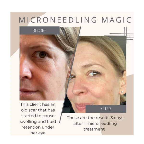 Before and After photo of micro-needling treatment