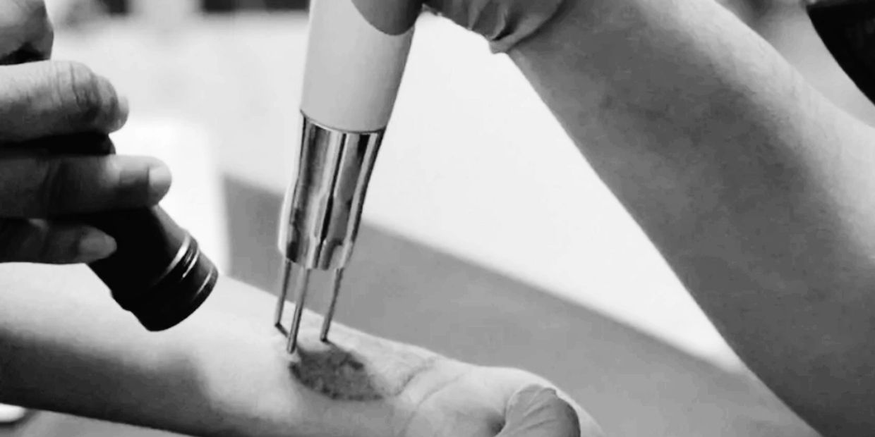 Close-up of a skin treatment using a specialized device on an arm.